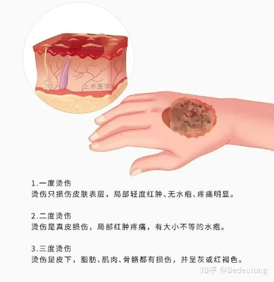 烫伤治疗全攻略，百度收录标准，实用指南与建议
