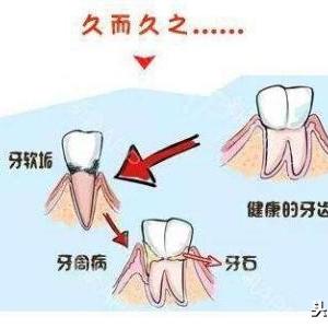 苏州洗牙攻略，专业护理，牙齿焕然一新