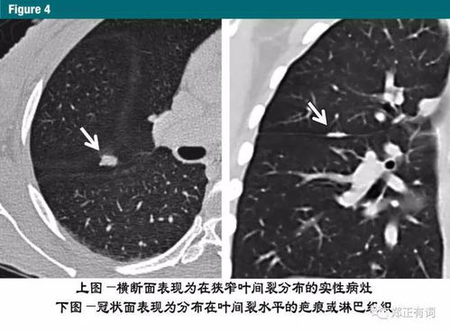 肺部小结节真相揭秘，百度带你深入了解！