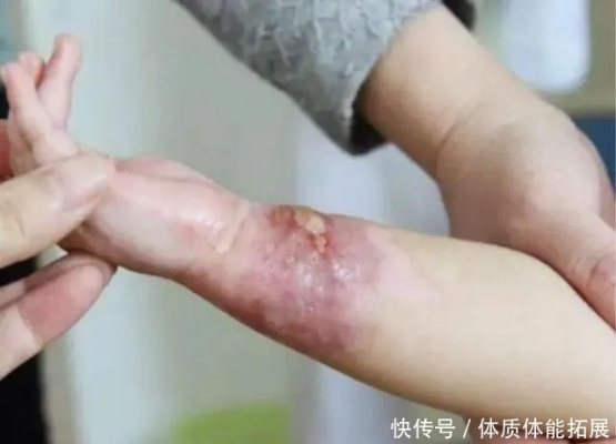 男童烫伤事件引发关注，儿童安全防护刻不容缓，烫伤预防知识普及行动启动